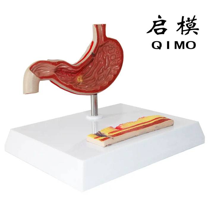 病理胃模型