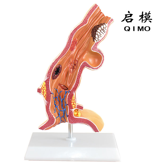 食管病理模型