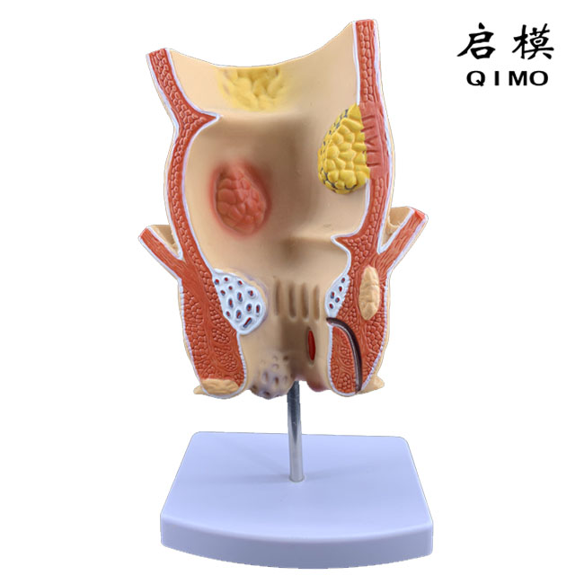 直肠病理模型