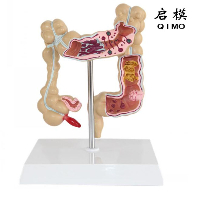 大肠病变模型