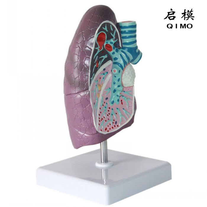 病理肺模型（肺部病变模型）