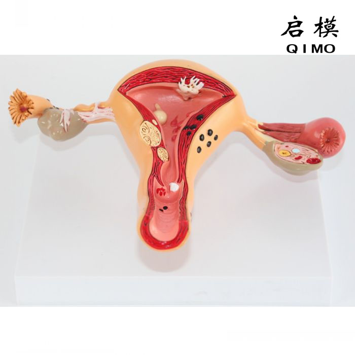 子宫卵巢病变模型