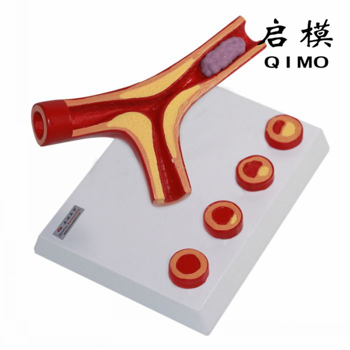 冠状动脉粥硬化带血栓模型