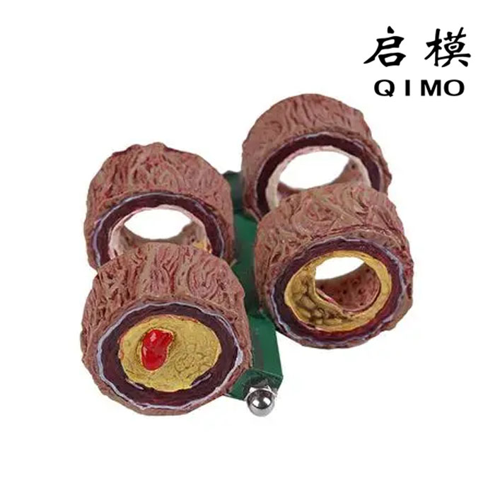 四阶段动脉粥样硬化血管阻塞模型