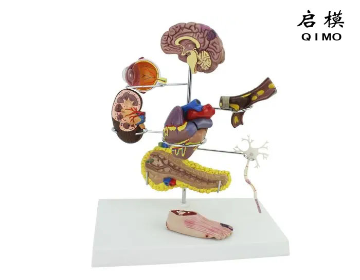 糖尿病模型