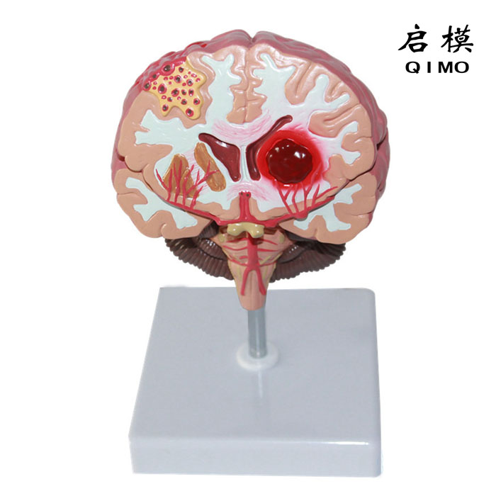 脑中风模型（大脑疾病模型）
