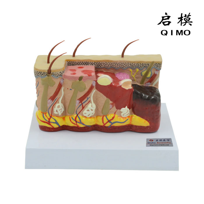 烧伤皮肤结构模型
