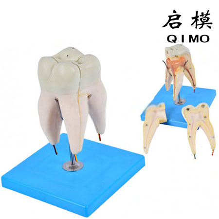 磨牙有三个牙根模型