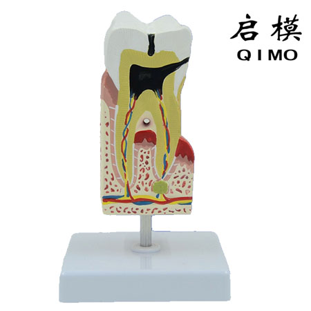 磨牙病理模型