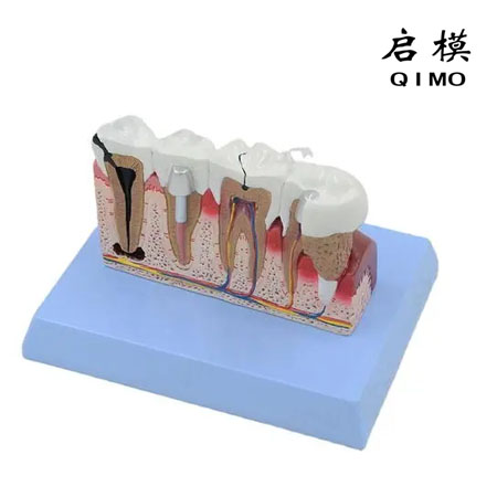 牙齿病变模型
