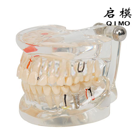 透明牙体病理模型