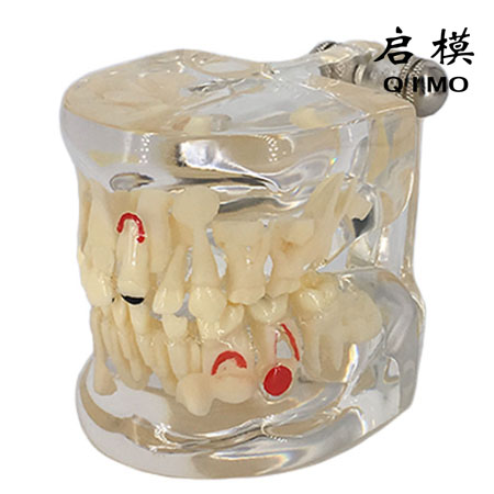 透明乳牙病理模型