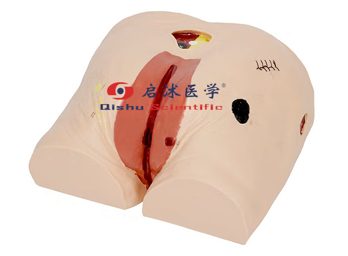 老年褥（压）疮护理模型
