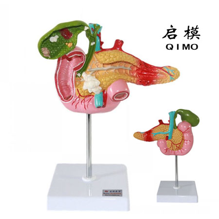 J1513胰腺十二指肠病变模型