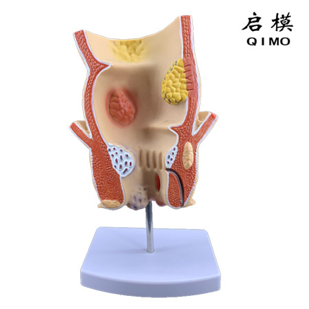 J1528直肠病理模型