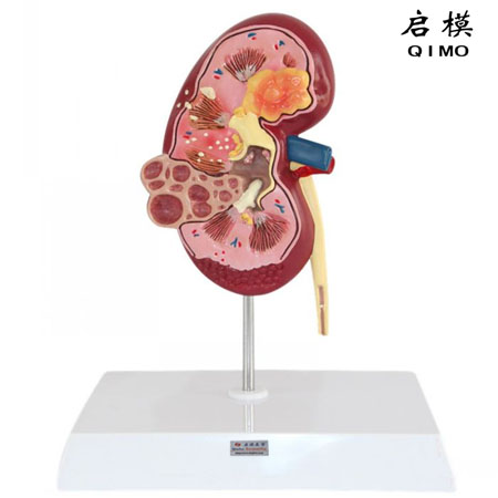 J1709肾脏病变模型